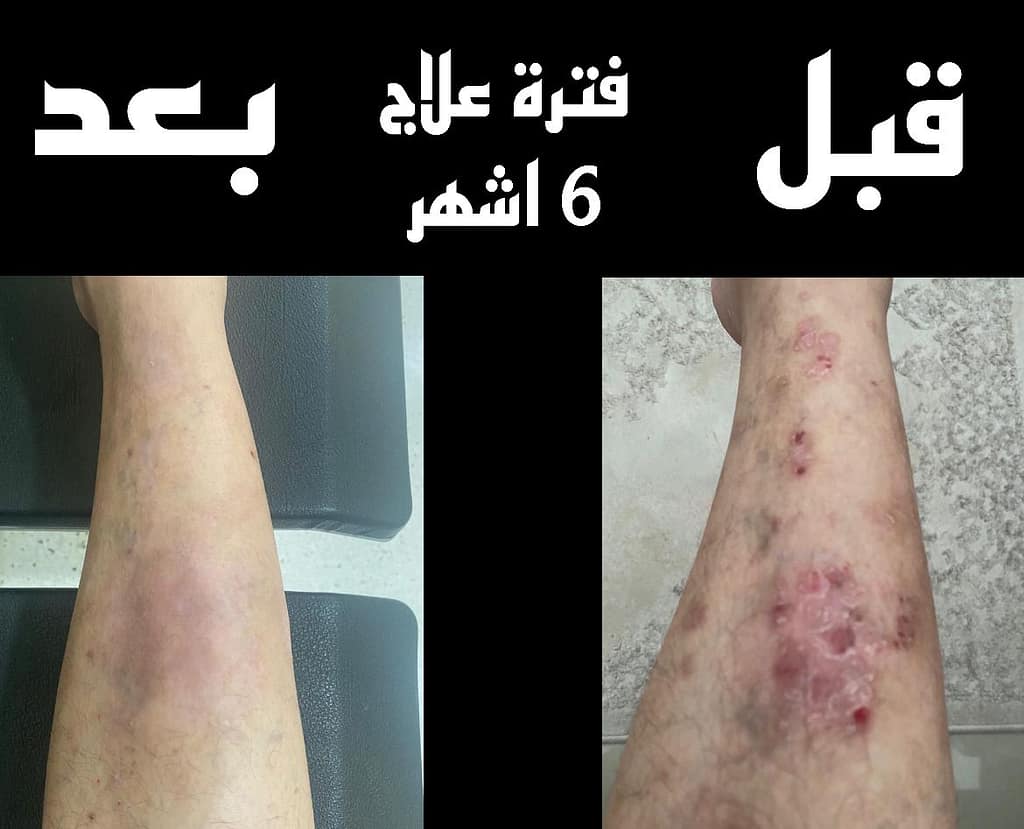 حالة تشافي من الصدفية2