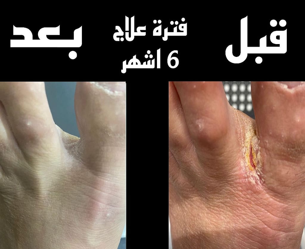 حالة تشافي من الصدفية3