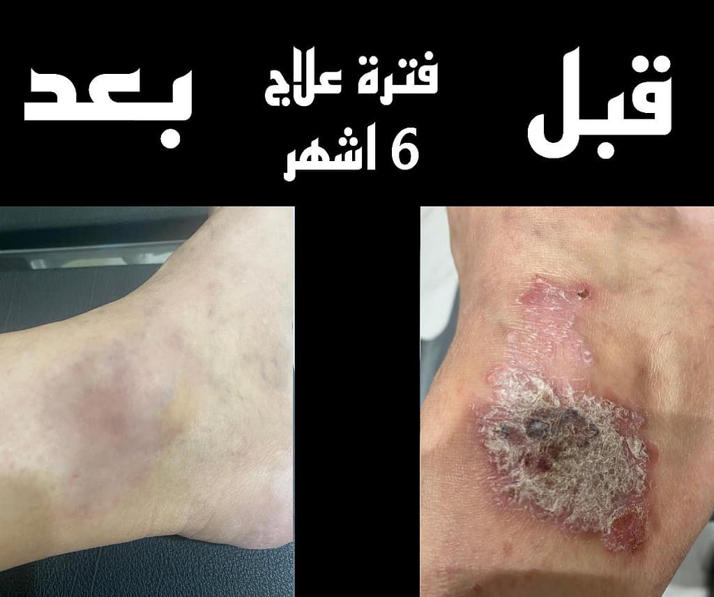 حالة تشافي من الصدفية1