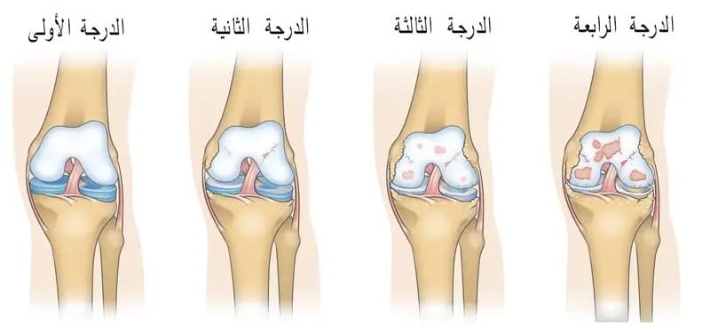 خشونة المفاصل درجات