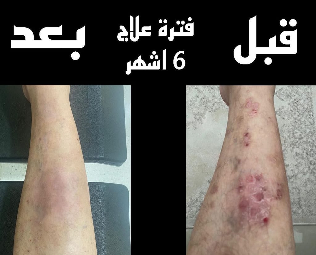 حالة تشافي من الصدفية2