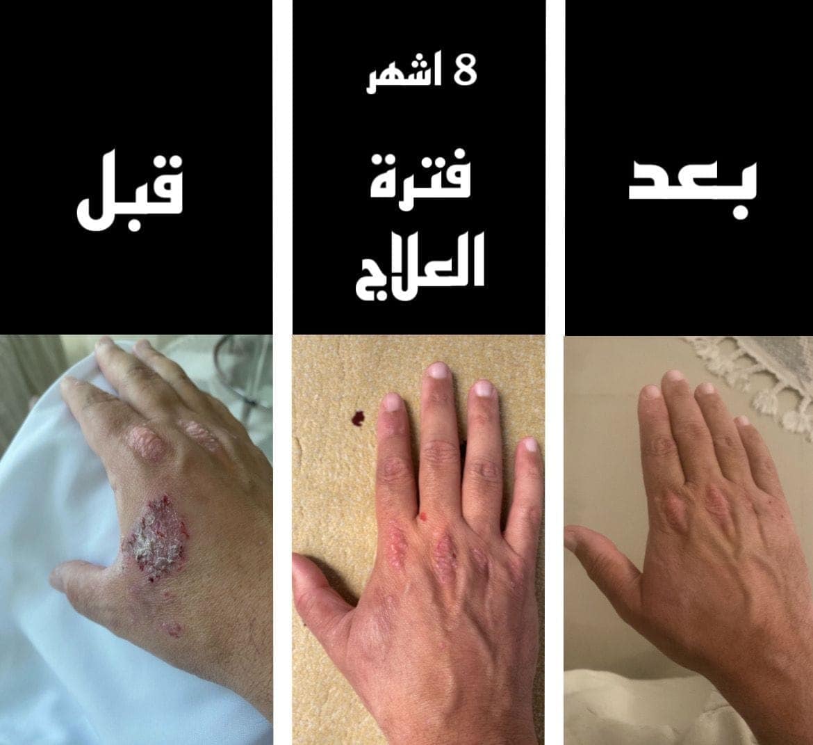 الصدفية